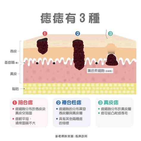 痣 形成原因|痣形成的原因？痣長毛、痣變多變大是痣病變？5招判。